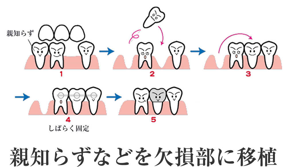 歯の移植、再植