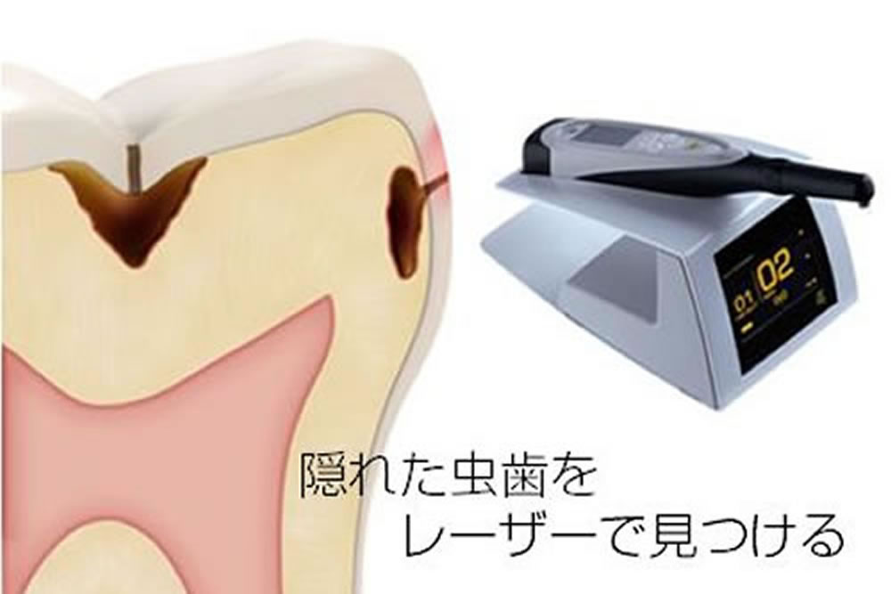 ダイアグノデント(虫歯検知器)