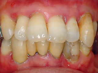 くさい 血が出る ウミが出る 薬で治す歯槽膿漏 しそうのうろう 歯周病 １