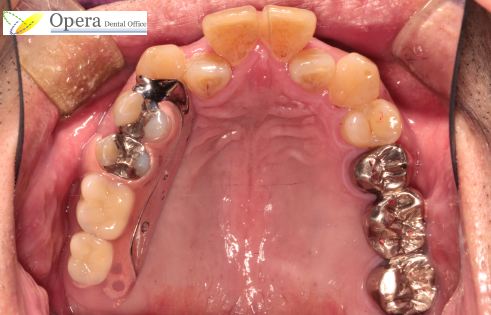 本 部分 入れ歯 奥歯 2